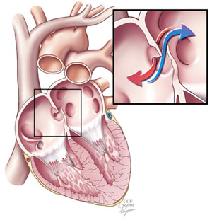 PFO diagram