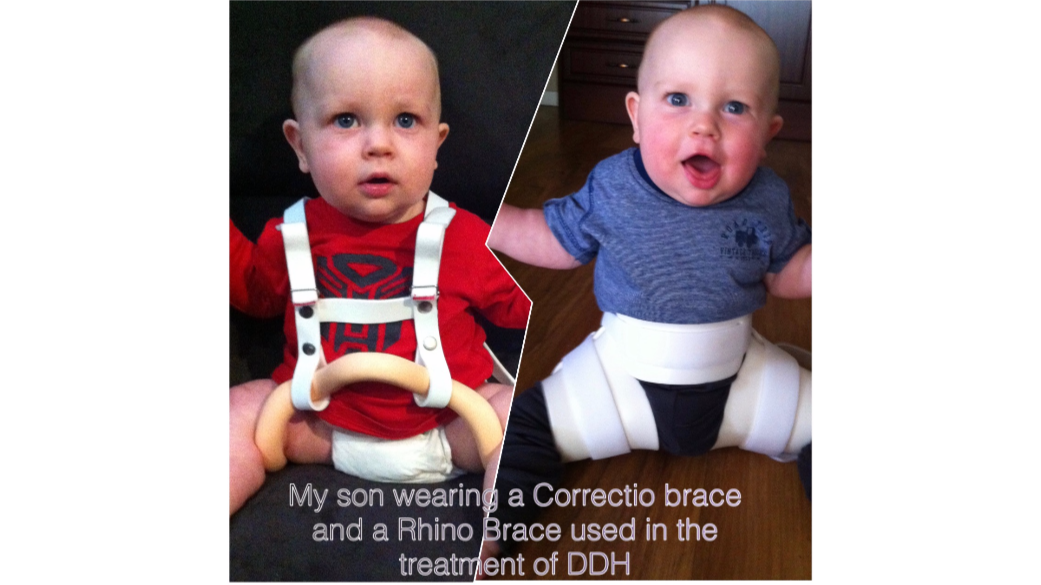Healthy Hips Kits for DDH Kids