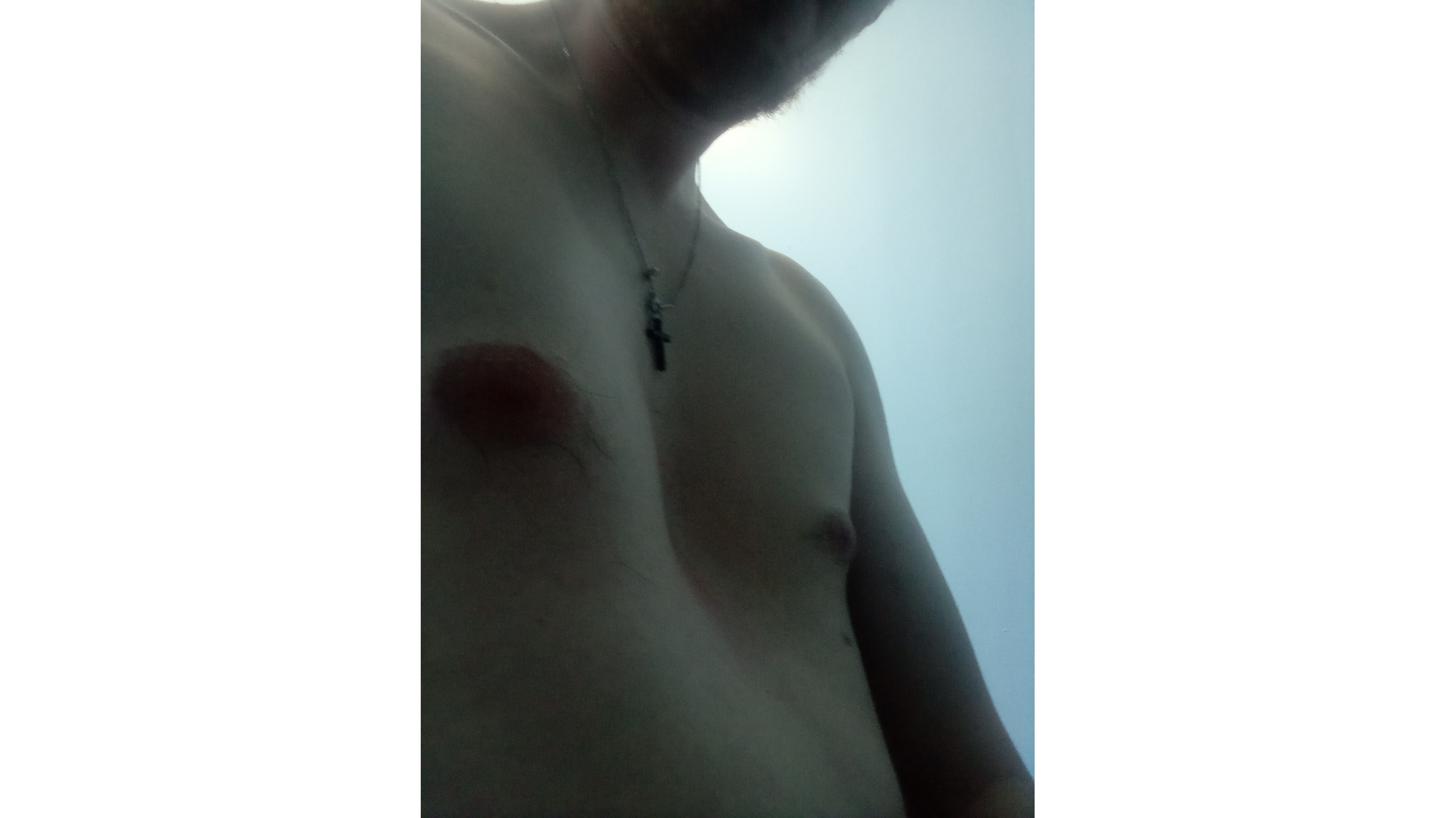 Anthony beating Pectus excavatum ( sunken chest)