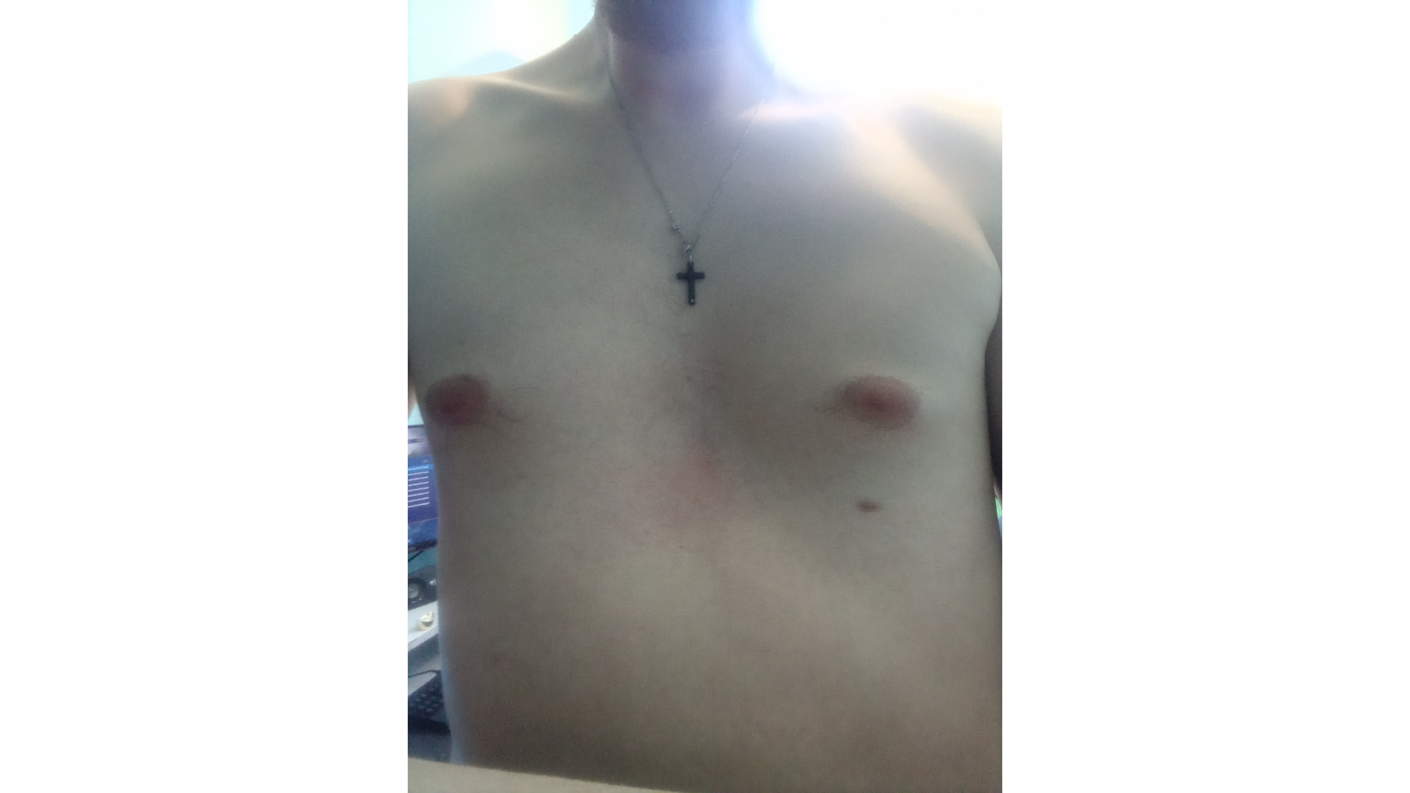 Pectus Excavatum Sunken Chest Causes And Risk Factors vrogue.co