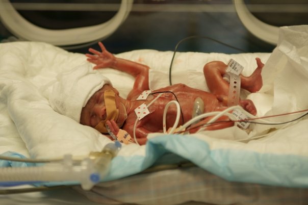 preemie babies in nicu